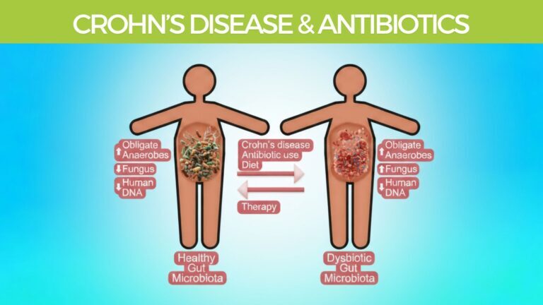 Crohn’s Disease Causes antibiotics microbiome
