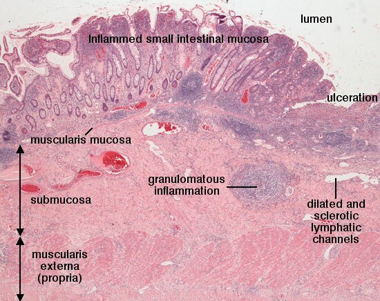 chrons disease symptoms and natural solutions