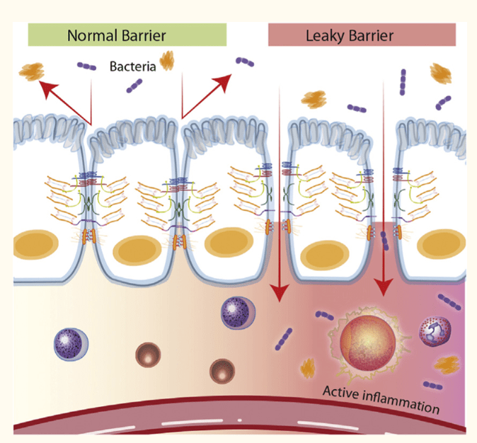 Leaky-Gut-Syndrome explained with natural solutions